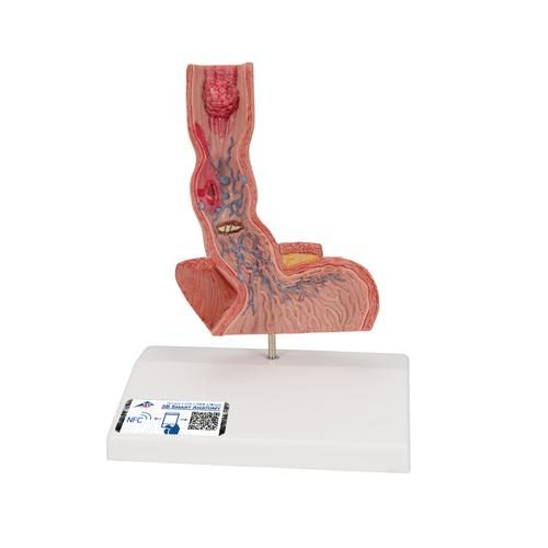 Anatomisches Modell des menschlichen Ösophagus mit Erkrankungen in natürlicher Größe