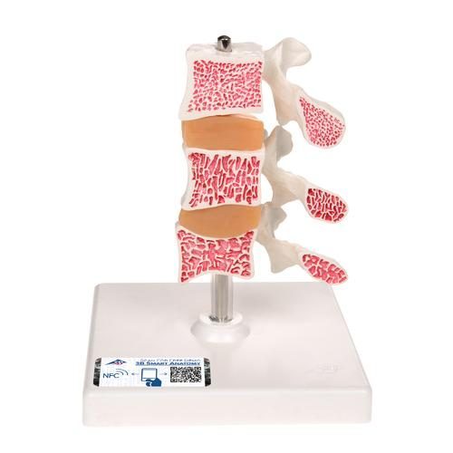 Deluxe human osteoporosemodel med 3 ryghvirvler og skiver aftagelig på stativ