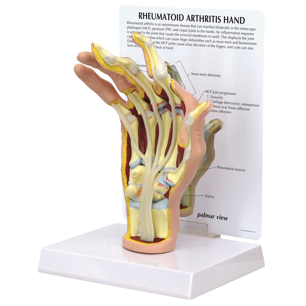 Rheumatoid Artrit Handmodell