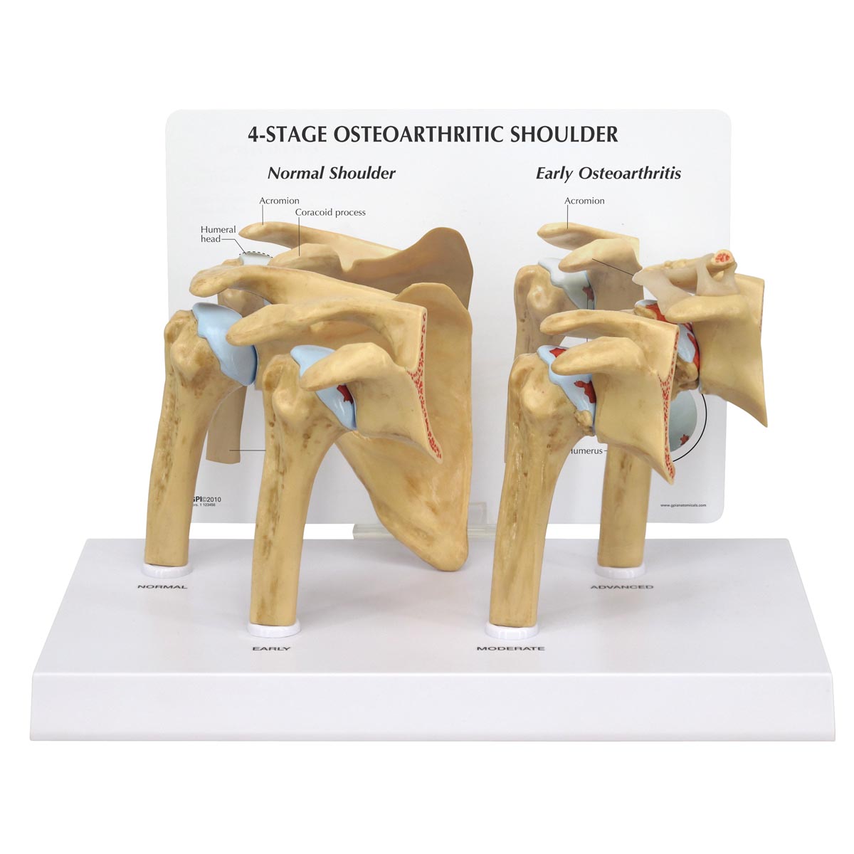 4-Stufen-Modell für Schulterarthrose (OA)